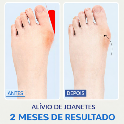 Corretor de joanete Align™